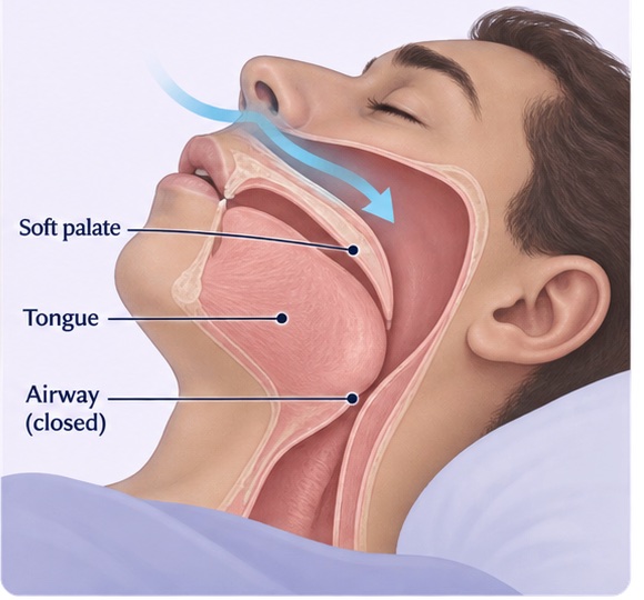Side-view airway illustration showing airflow stopping at a closed upper airway.